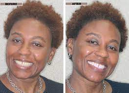 You just need to undergo the whole process on the dentist chair, wait it out, and voila! Zoom Whitening Cosmetic Teeth Whitening In Brooklyn