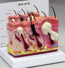 Gpi Human Skin Acne Anatomical Model 1573gpi Acne Cystic Acne Treatment Acne Remedies Fast