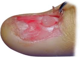 Image result for Glomus tumor