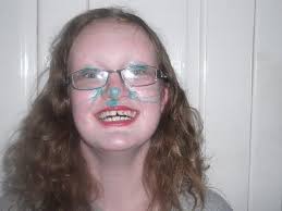 Teenager Iona battling rare 'second skeleton' disease