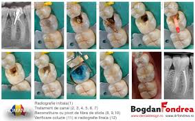 Implant all on 4 / all on 6. Cum Se Realizeaza Un Tratament De Canal Dr Bogdan Fondrea