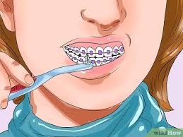 How to floss with braces. How To Clean Teeth With Braces 12 Steps With Pictures Wikihow