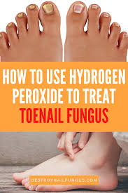 What You Need To Know About Hydrogen Peroxide And Toenail Fungus
