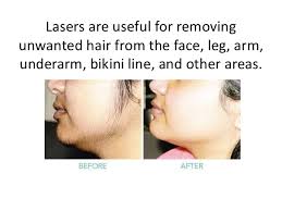 The typical cost of laser hair removal varies. Best Hair Removal Treatment In Hyderabad