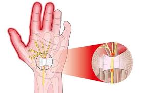 Carpal tunnel syndrome is one of the most common problems affecting the hand. Causes Of And Treatment For Carpal Tunnel Syndrome Step To Health