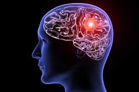 Il principale è un mal di testa lancinante e improvviso, tipico segnale della rottura di un l'aneurisma cerebrale è una malformazione vascolare a carico delle arterie cerebrali che si manifesta con un rigonfiamento di un vaso sanguigno del cervello. Zam1zeytkri3cm