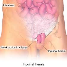 In women, it can be connected with menstruation, miscarriage, or complications in the female reproductive organs. General Surgery Inguinal Hernia