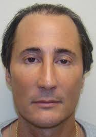 Best Hair Restoration Doctors For Men And Women in Delaware New Castle Heather  Valley