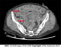 Image result for Radiation Colitis