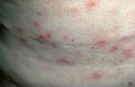 How to get rid of hot tub rash bacteria. Acne Like Breakouts Could Be Folliculitis