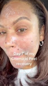 Day 7 of my chemical peel recovery. Where do you think I'm headed?? ✈️...