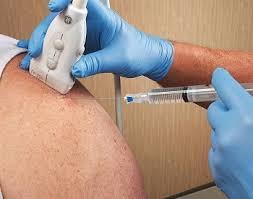 Image result for Biceps Tendon Injection