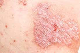 Dermatitis adalah keluhan kesehatan berupa peradangan yang terjadi pada kulit. 8 Kondisi Fisik Penyebab Kulit Bersisik Indozone Id