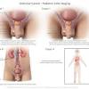 But for testicular cancer, this could spread the cancer, so the biopsy is done during surgery to take out the cancer. 1
