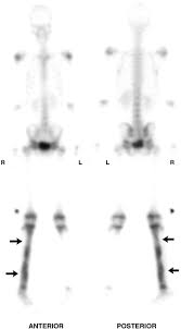 Image result for Osteomyelitis Bone Scan