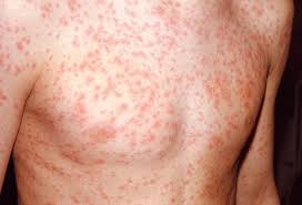 However, people who have herpes simplex virus. Viral Skin Conditions Pictures Of Rashes Blisters And Sores In Adults And Toddlers