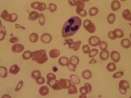 Image result for Anemia angolensis