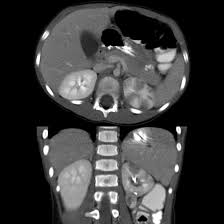 Image result for Acute Pyelonephritis