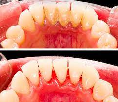 Best Dentist For Scaling Polishing In Bommanahalli Btm Layout