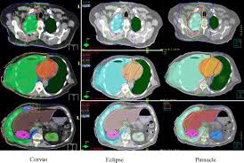 Usually, this cancer is found in the lining of the lungs and th. Treatment Planning System Evaluation For Mesothelioma Imrt Lung Cancer