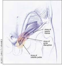 The groin is the superficial area where the trunk and the legs meet; Groin Injuries In Athletes American Family Physician