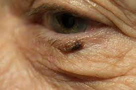 Some types of skin cancer are more dangerous than others, but if you have a spot. Eyelid Skin Cancer And Tumors Harris Eye And Facial Plastic Surgery