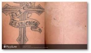 Laser tattoo removal is quick, easy and noninvasive thanks to our advanced laser technology. Boston Dermatologist Discusses The Tattoo Removal Revolution Skincare Physicians