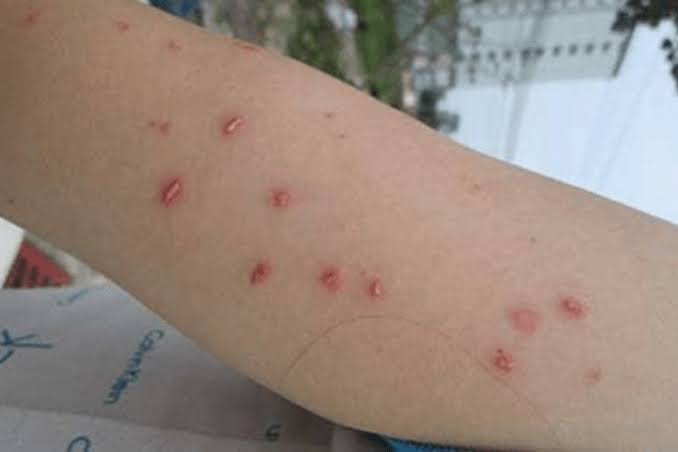 Kiến ba khoang cắn bôi thuốc gì? dấu hiệu nhận biết