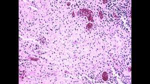 Salmonella infection (salmonellosis) is a common bacterial disease that affects the intestinal tract. Typhoid Fever Salmonella Typhi Youtube