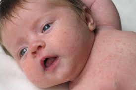 Si votre bébé a de l'acné, il peut avoir ces petits boutons dès la naissance, ou ils peuvent apparaître au bout d'une ou. Dossier Les Boutons Chez L Enfant Comment Les Differencier Kangourou Kids