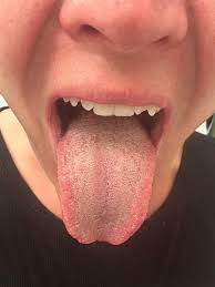 Image result for Oral thrush roof of mouth