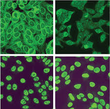 Image result for ANA Staining Pattern