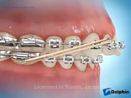 Elastics Class Ii Correction Overjet Youtube Orthodontic Rubber Bands Dental Braces Orthodontics