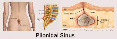When it's infected, a pilonidal cyst becomes a swollen mass (abscess). Pilonidal Sinus Causes Symptoms And Treatments In Dubai