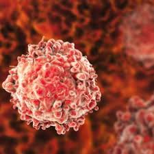 Leukemia starts when the dna of a single cell in the bone marrow changes (mutates) and can't treatments for leukemia depend on the type of leukemia you have, your age and overall health, and. Leukemia Medlineplus