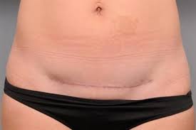 The surgeon sews up the incision in the mother's abdomen. Oh Baby Now That S A Scar Scar Release C Sections The Nesting Place Li