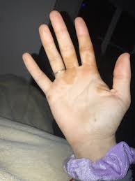 Random orange spots on hands. Page 3 What Are These Orange Stains That Have Appeared On My Hands Overnight Gransnet