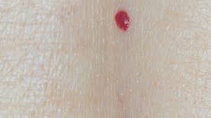 Cherry angioma, a common growth created by a collection of small blood angiomas are benign tumors that stem from an overgrowth of capillaries, dr. Skin Heir To Variety Of Benign Growths With Age Ctv News