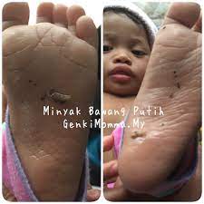 Anda boleh meletakkan bawang putih atau lemon di dalamnya, jika mahu. Cara Buat Minyak Bawang Putih Untuk Bayi Selesema Berkahak Genkimomma My