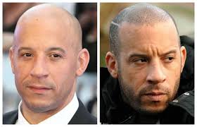 We are experts in all hair and scalp problems. Scalp Micropigmentation Elite Look