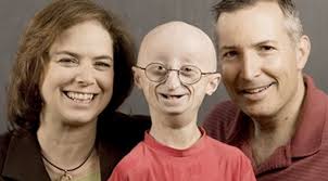 Yes, benjamin button disorder is called progeria. Real Life Benjamin Button Sam Berns Dies At 17 From Rare Aging Disease Png 395 218 Sam Berns Real Life Rare Disease