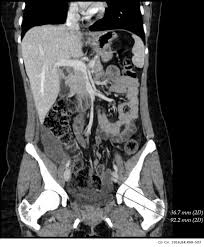 Imaging is important in diagnosing mesothelioma.it will provide information such as the extent of disease in the original organ and also show if the cancer has spread to. Recurrent Benign Multicystic Peritoneal Mesothelioma Approach To This Rare Condition Cirugia Y Cirujanos English Edition