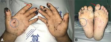 Hallmark Cutaneous Signs of Infective Endocarditis - Dr Qaisar Ahmed MD, DHMS