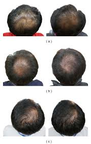 Pumpkin Seeds And Hair Growth Http Www Ncbi Nlm Nih Gov Pmc Articles Pmc4017725 Pumpkin Seed Oil Hair Hair Loss Remedies Women Hair Loss Cure