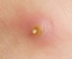 How to treat armpit boils. Boils Abscesses Health Navigator New Zealand