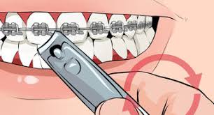 Orthodontic bracket remover braces remover pliers while removing a bracket, grip the upper and lower wings of the bracket between the jaws of the pliers and press the handle of the pliers gently. How To Prepare For Getting Braces Removed 12 Steps