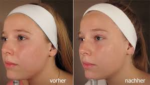Kaum in der pubertät, beginnt alles zu wachsen, vor allem die pickel im gesicht sprießen. Narbenbehandlungen In Berlin Zehlendorf Dr Med Meike Schroder