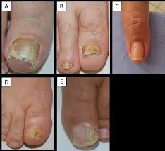Image result for onychomycosis