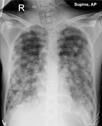 Shortness of breath, chest pain, or a cough (even coughing up blood) may develop from cancer spread in the lungs. Lung Metastases Testicular Choriocarcinoma Radiology Case Radiopaedia Org