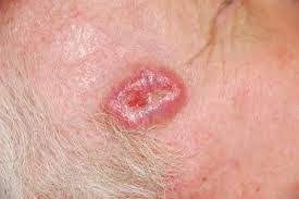 They develop from basal cells and these are found in the deepest part of the outer layer of the skin (the epidermis). Basal Cell Carcinoma Rodent Ulcers
